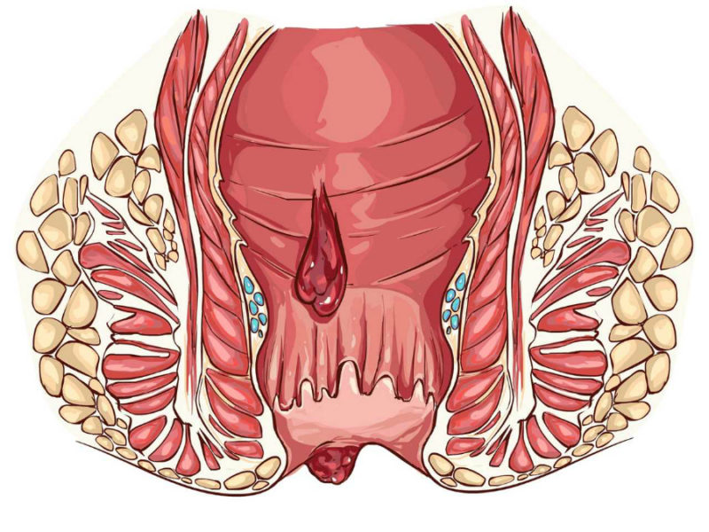 Виды геморроя: как распознать симптомы и не допустить развитие болезни