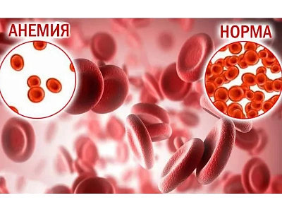 Способы эффективной профилактики анемии